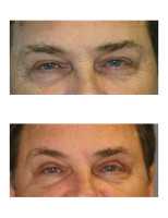 eyelid-surgery-blepharoplasty_002