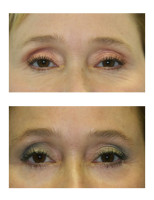 eyelid-surgery-blepharoplasty_003