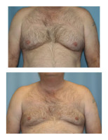 gynecomastia-male-breast-reduction_003