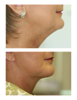 neck-liposuctions_002