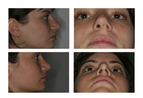 nose-reshaping_002