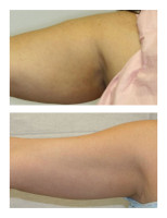 arm-liposuction001