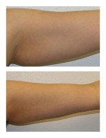 arm-liposuction002