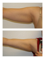 arm-liposuction003