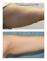 arm-liposuction004