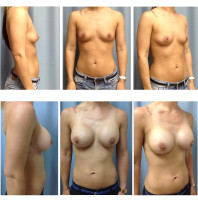 breast-augmentation-hidden-incision_001