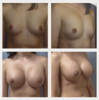 breast-augmentation-hidden-incision_002