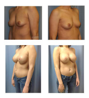 breast-augmentation-hidden-incision_003