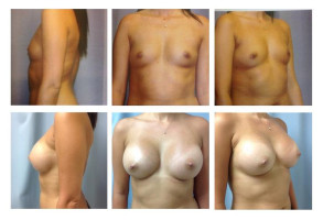 breast-augmentation-hidden-incision_004