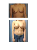 breast-augmentation-hidden-incision_009