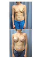 breast-augmentation-hidden-incision_010