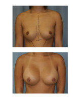 breast-augmentation-hidden-incision_011