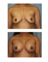 breast-augmentation-hidden-incision_013