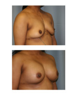 breast-augmentation-hidden-incision_014