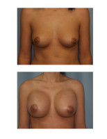 breast-augmentation-hidden-incision_016
