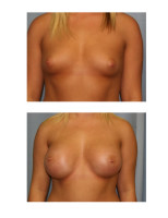 breast-augmentation-hidden-incision_017
