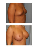 breast-augmentation-hidden-incision_018