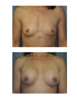 breast-augmentation-hidden-incision_019