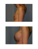 breast-augmentation-hidden-incision_021