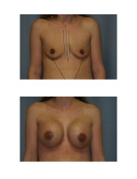 breast-augmentation-hidden-incision_022