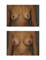 breast-augmentation-hidden-incision_024
