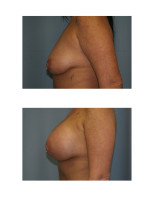 breast-augmentation-hidden-incision_025