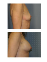 breast-augmentation-hidden-incision_026