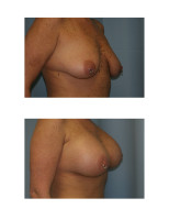 breast-augmentation-hidden-incision_027