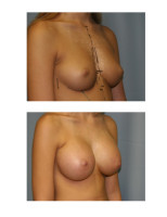 breast-augmentation-hidden-incision_029