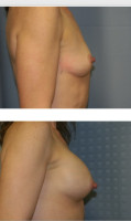 breast-augmentation-hidden-incision_030