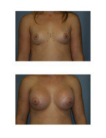 breast-augmentation-hidden-incision_031