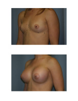 breast-augmentation-hidden-incision_032
