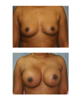breast-augmentation-hidden-incision_033
