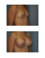 breast-augmentation-hidden-incision_035
