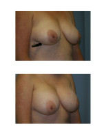 breast-augmentation-hidden-incision_037