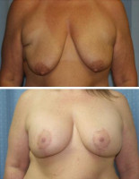 breast-augmentation_038