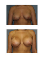 breast-augmentation-hidden-incision_040