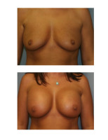 breast-augmentation-hidden-incision_042