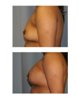 breast-augmentation-hidden-incision_044