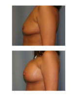 breast-augmentation-hidden-incision_046