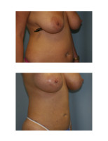 breast-augmentation-hidden-incision_047