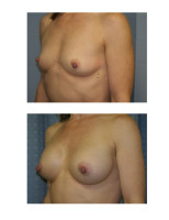 breast-augmentation-hidden-incision_048