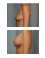 breast-augmentation-hidden-incision_050