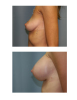 breast-augmentation-hidden-incision_053