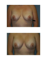 breast-augmentation-hidden-incision_056