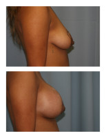 breast-augmentation-hidden-incision_057