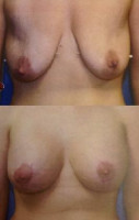 breast-augmentation-_059