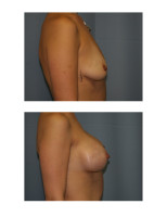 breast-augmentation-hidden-incision_061