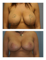 breast-augmentation-no vertical-scar-lift_002