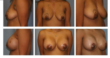 breast-augmentation-with-lift_004